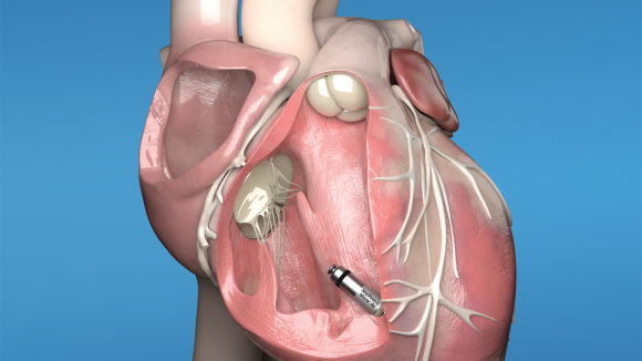 Technologie w dobrym rytmie - diagnostyka i leczenie zaburzeń rytmu serca
