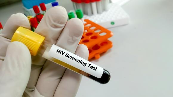 Niewielki odsetek Polaków wykonuje testy w kierunku HIV. Wirus może pozostawać w uśpieniu nawet 10 lat