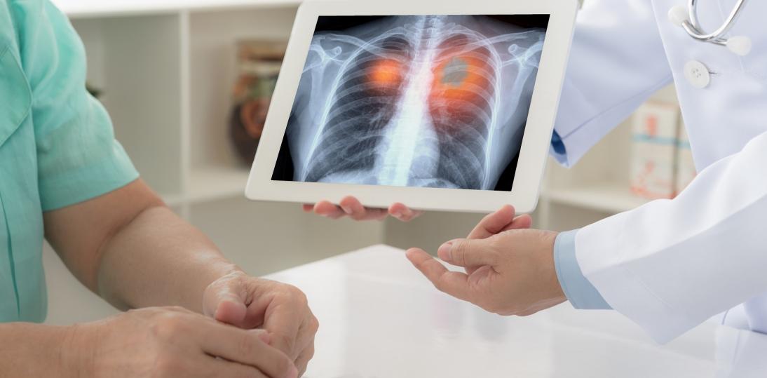 Nowe metody leczenia raka płuca – rosną szanse medycyny w walce z tym nowotworem