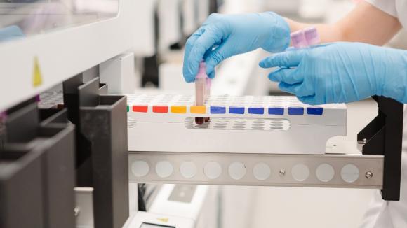 Etap przedanalityczny istotny dla wiarygodności wyników diagnostycznych badań laboratoryjnych