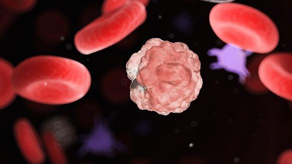 Chłoniak grudkowy oraz DLBCL – priorytety refundacyjne w hematologii w 2023 roku