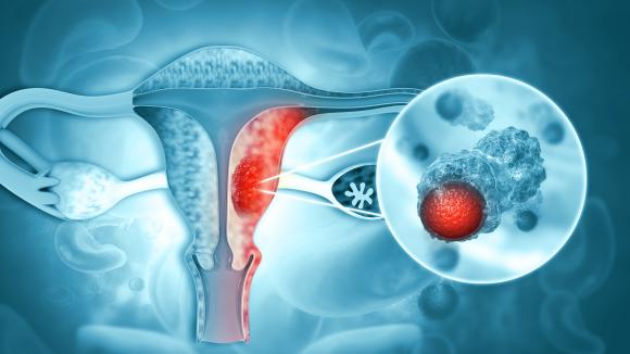 Diagnozę raka endometrium co roku słyszy kilka tysięcy Polek