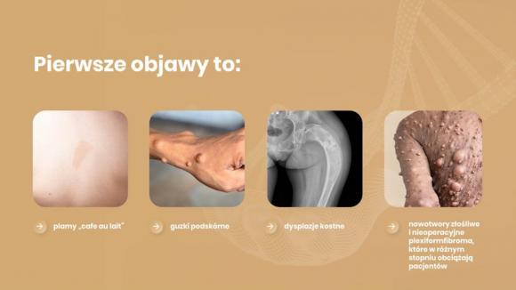 „Ludzie boją się podać rękę, odwracają wzrok na ich widok…” 17 maja - Światowy Dzień Neurofibromatoz