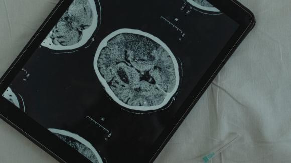 Światowy Dzień Mózgu:  aby lepiej leczyć choroby mózgu, konieczne są inwestycje w neurologię