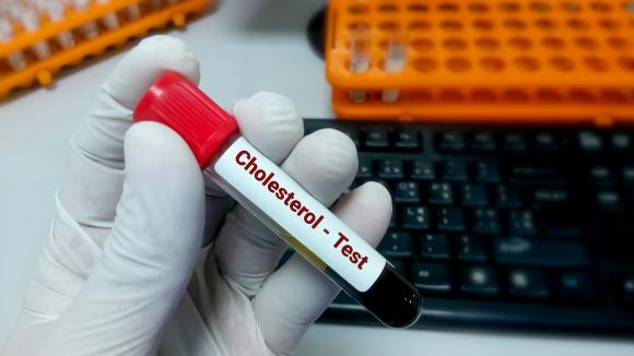 Cholesterol nie boli. Dowiedz się kiedy należy rozpocząć leczenie