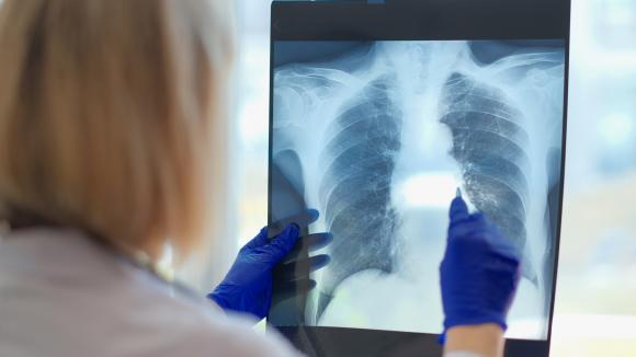 Wrześniowa lista refundacyjna przyniosła kolejne dobre wiadomości dla pacjentów z rakiem płuca