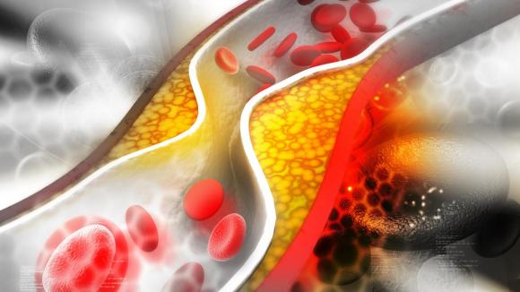 Czas na skuteczne leczenie hipercholesterolemii - apelują pacjenci, klinicyści oraz parlamentarzyści