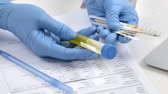 Prosty test moczu może zrewolucjonizować wczesne wykrywanie raka prostaty