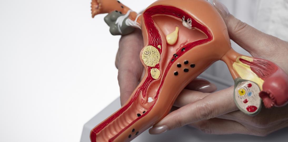 Od 1 lipca 2025 r. rusza kompleksowa opieka nad endometriozą – NFZ sfinansuje leczenie zaawansowanych przypadków