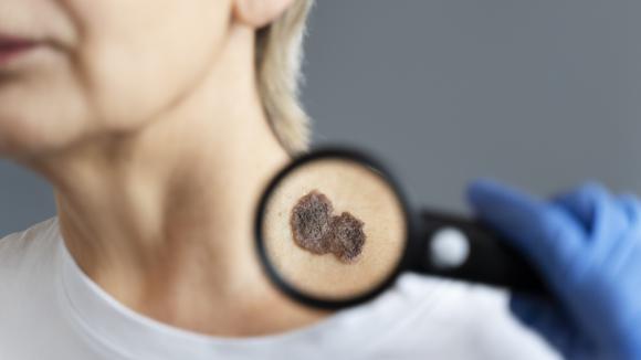 Wakacje terapeutyczne w leczeniu czerniaka – polscy naukowcy wskazują bezpieczny moment zakończenia terapii