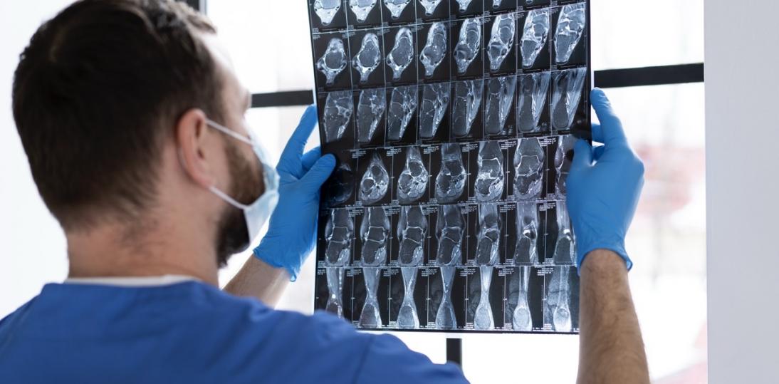 Udary mózgu: coraz skuteczniejsze leczenie, wciąż kulejąca rehabilitacja
