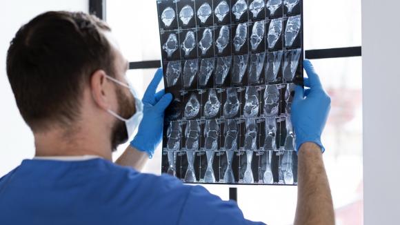 Udary mózgu: coraz skuteczniejsze leczenie, wciąż kulejąca rehabilitacja