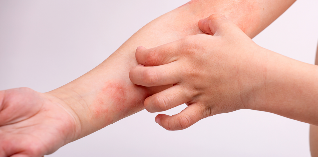 Atopowe zapalenie skóry bez granic. Gdzie AZS leczy się skuteczniej?