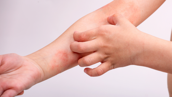 Atopowe zapalenie skóry bez granic. Gdzie AZS leczy się skuteczniej?
