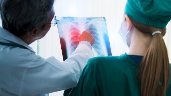 Zaawansowane prace nad terapią komórkową raka płuca na Uniwersytecie Gdańskim. Odkrycia projektu SWIFT wesprą też diagnostykę tej choroby
