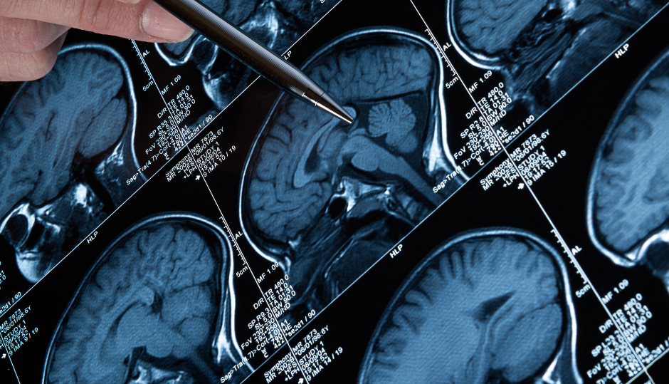 Stwardnienie rozsiane a borelioza. Czy można je pomylić?