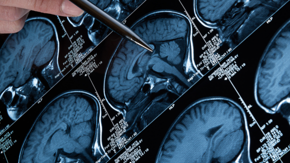 Stwardnienie rozsiane a borelioza. Czy można je pomylić?