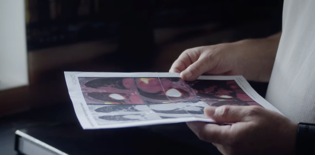 Drobnokomórkowy rak płuca – historia, która daje nadzieję