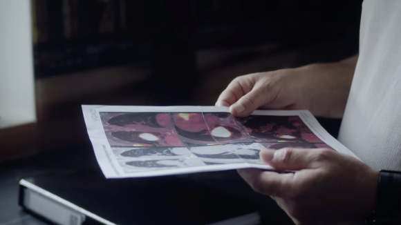 Drobnokomórkowy rak płuca – historia, która daje nadzieję