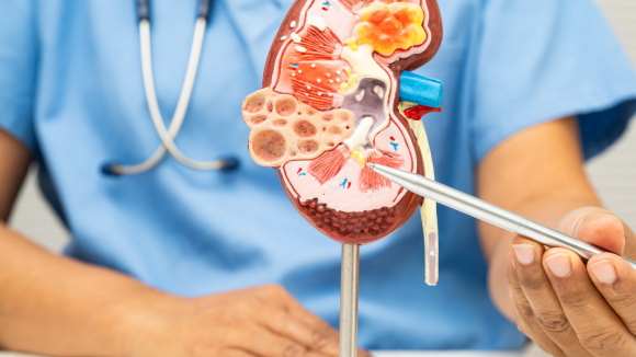 Pierwotna hiperoksaluria – rzadka choroba, która niszczy nie tylko nerki. Dziś jest możliwa do leczenia