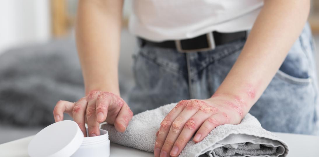 Atopowe zapalenie skóry to nie tylko „alergia”. Co decyduje o przebiegu choroby i jak dziś skutecznie ją leczyć?