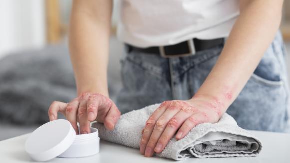 Atopowe zapalenie skóry to nie tylko „alergia”. Co decyduje o przebiegu choroby i jak dziś skutecznie ją leczyć?