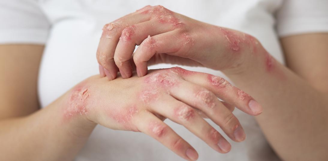 Łuszczyca to nie tylko choroba skóry. Co dziś naprawdę wiemy o jej przyczynach, przebiegu i leczeniu?