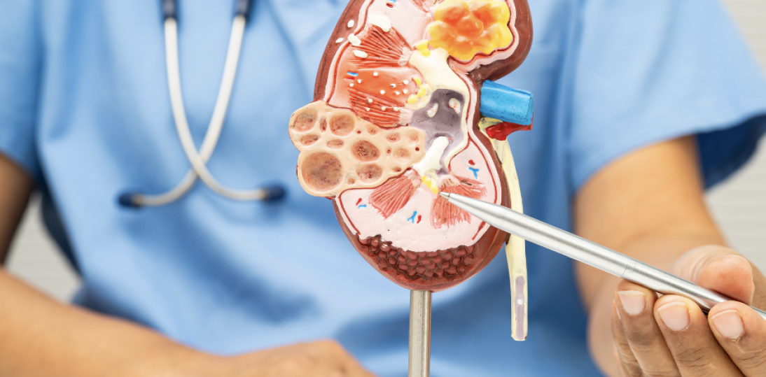 Pierwotna hiperoksaluria: wyzwania diagnostyczne i konieczne zmiany systemowe