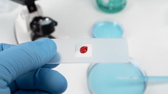 Standardy leczenia nowotworów krwi dynamicznie się zmieniają. W programach lekowych dostępne są nowe metody terapeutyczne