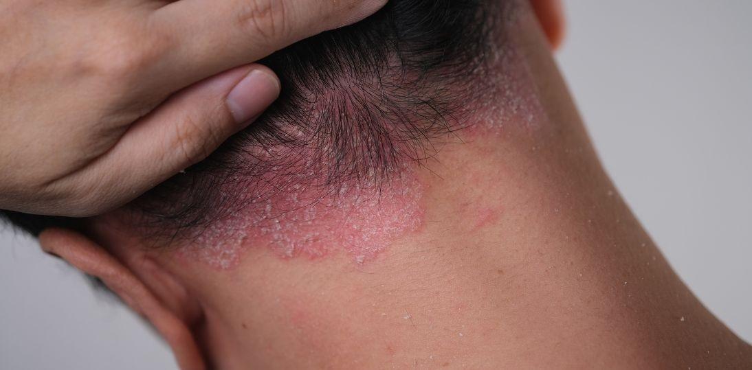 Tabletka zamiast zastrzyku? FDA zatwierdza icotrokinrę – nowy kierunek leczenia łuszczycy plackowatej