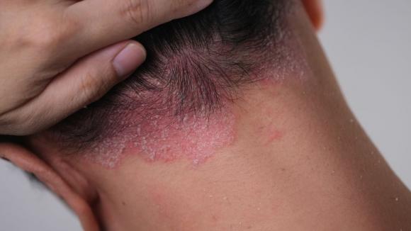 Tabletka zamiast zastrzyku? FDA zatwierdza icotrokinrę – nowy kierunek leczenia łuszczycy plackowatej