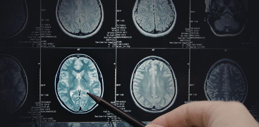 Polskie badania ujawniają skomplikowany rozwój choroby Huntingtona