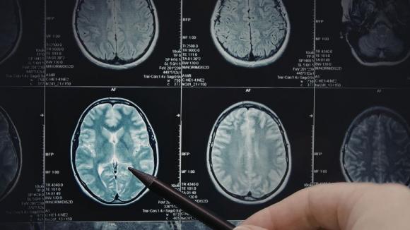 Polskie badania ujawniają skomplikowany rozwój choroby Huntingtona