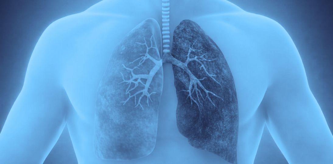 Nowa terapia biologiczna w POChP. Tozorakimab zmniejsza liczbę zaostrzeń w dwóch badaniach III fazy