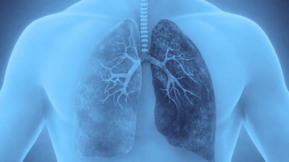 Nowa terapia biologiczna w POChP. Tozorakimab zmniejsza liczbę zaostrzeń w dwóch badaniach III fazy