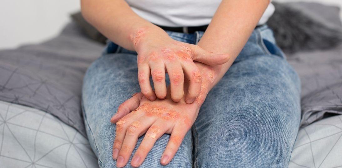 Łuszczyca: czy skuteczne leczenie doustne może zmienić standard terapii?