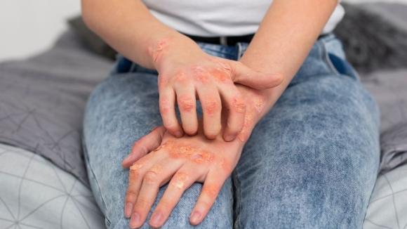 Łuszczyca: czy skuteczne leczenie doustne może zmienić standard terapii?