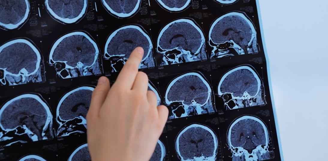 Stwardnienie rozsiane u dzieci i młodzieży: objawy, leczenie i wyzwania systemowe w Polsce