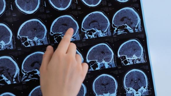 Stwardnienie rozsiane u dzieci i młodzieży: objawy, leczenie i wyzwania systemowe w Polsce