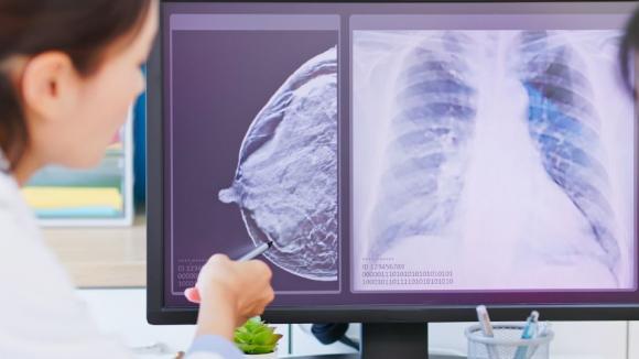 Ekspert UMW współtworzył polską edycję najnowszych wytycznych NCCN dotyczących raka piersi