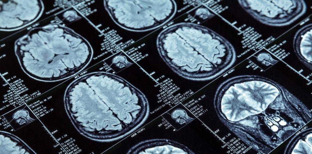 Obrazowanie mózgu ujawnia podtypy migreny – odkrycie naukowców ze Stanford Medicine