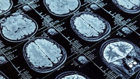 Obrazowanie mózgu ujawnia podtypy migreny – odkrycie naukowców ze Stanford Medicine