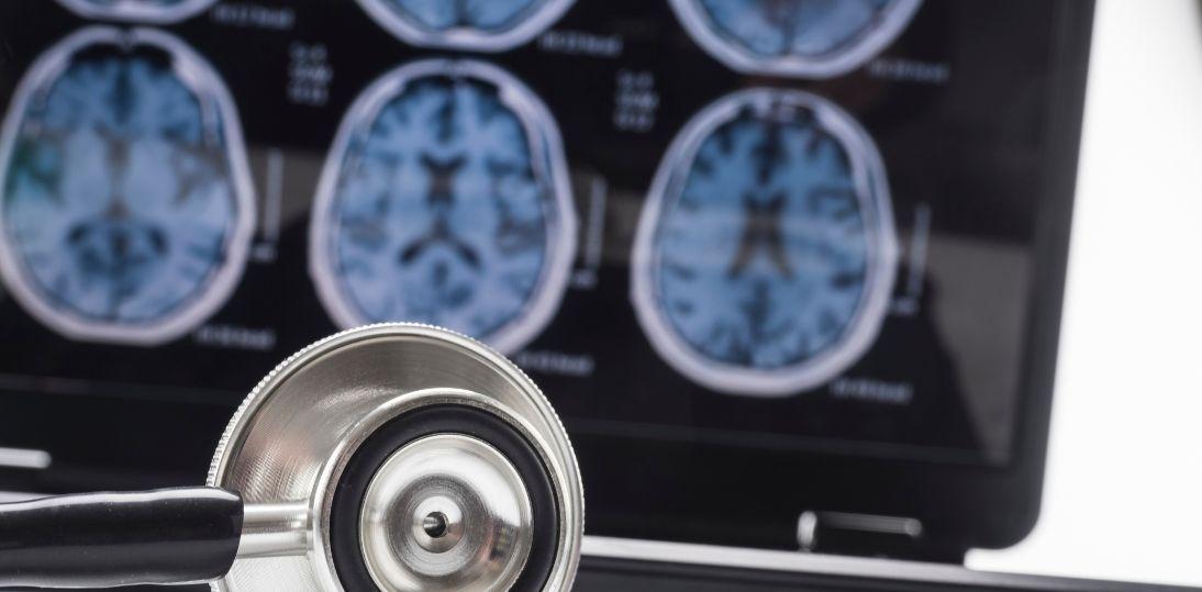 Trombektomia mechaniczna coraz bardziej dostępna. Liczba ośrodków leczenia udaru w Polsce wzrosła ponad dwukrotnie