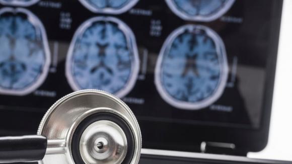 Trombektomia mechaniczna coraz bardziej dostępna. Liczba ośrodków leczenia udaru w Polsce wzrosła ponad dwukrotnie