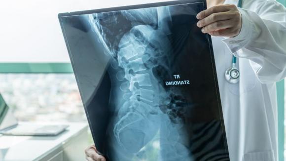 SMA staje się chorobą przewlekłą. Eksperci stawiają na personalizację leczenia i opiekę przez całe życie