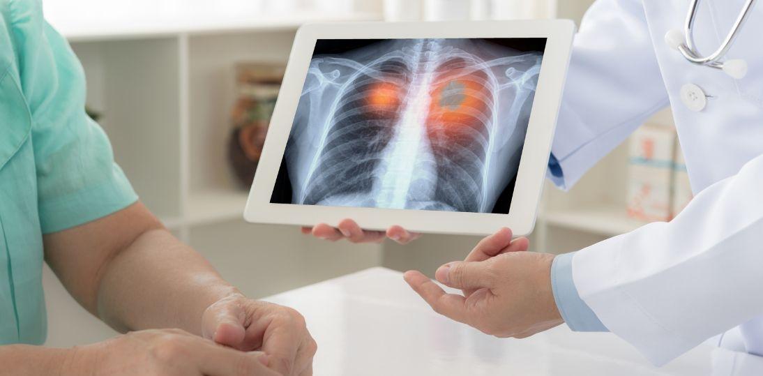 Eksperci: spektakularne wyniki leczenia niedrobnokomórkowego raka płuca dzięki nowym terapiom