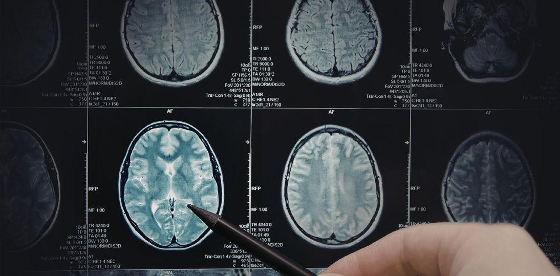 Neurochirurg: glejak wciąż jest jednym z najtrudniejszych nowotworów do leczenia