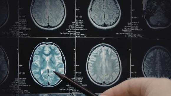 Neurochirurg: glejak wciąż jest jednym z najtrudniejszych nowotworów do leczenia
