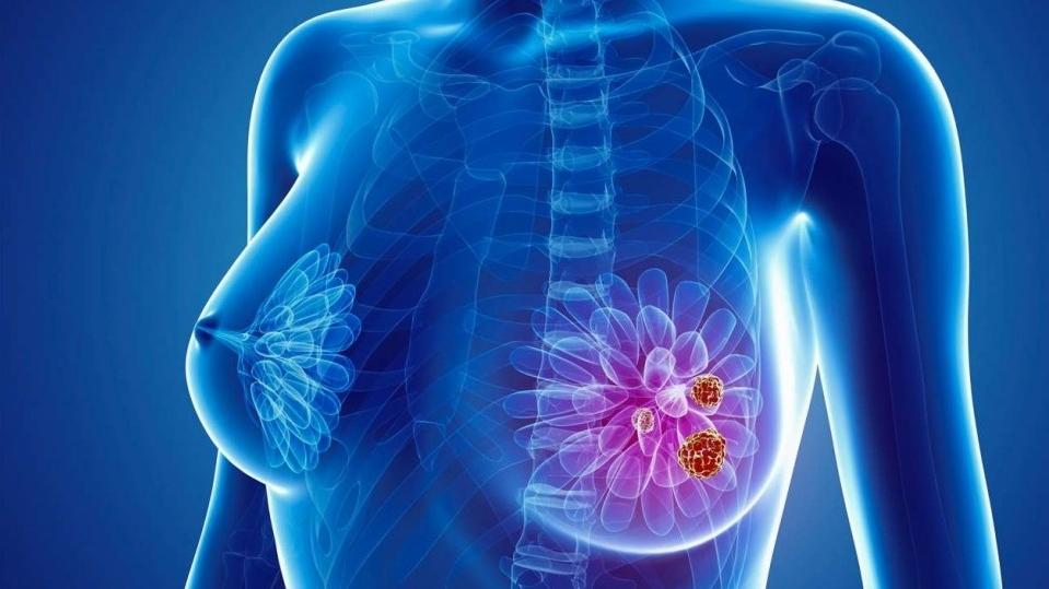 NCCN publikuje aktualne wytyczne dot. leczenia raka piersi