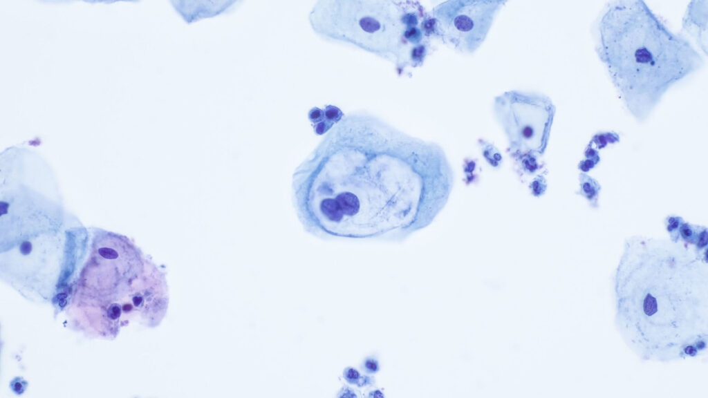 Cytologia LBC to większa wiarygodność badania, skuteczniejsze profilaktyka i leczenie
